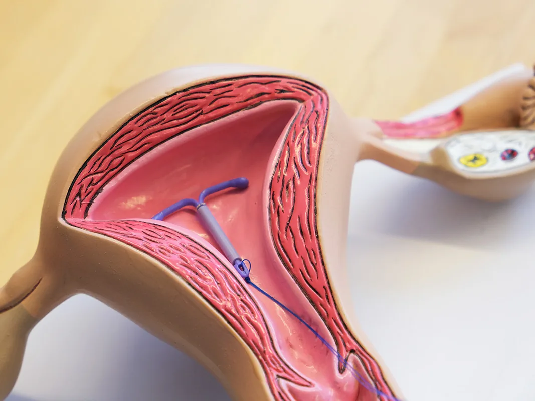 Gynäkologische Beratung und Verhütung Anatomisches Modell der weiblichen Geschlechtsorgane mit Spirale zur Verhütungsberatung